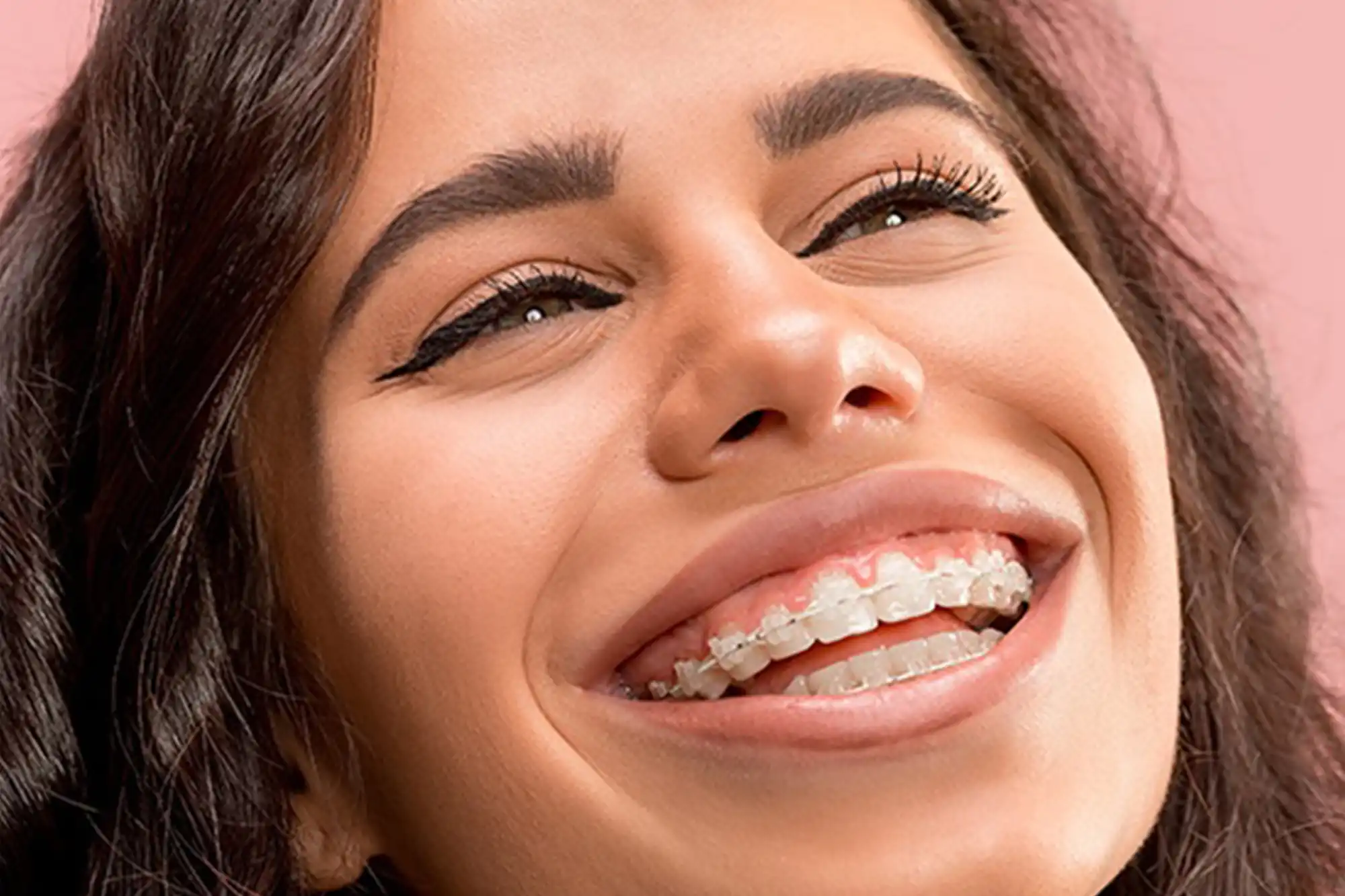 Clear Braces