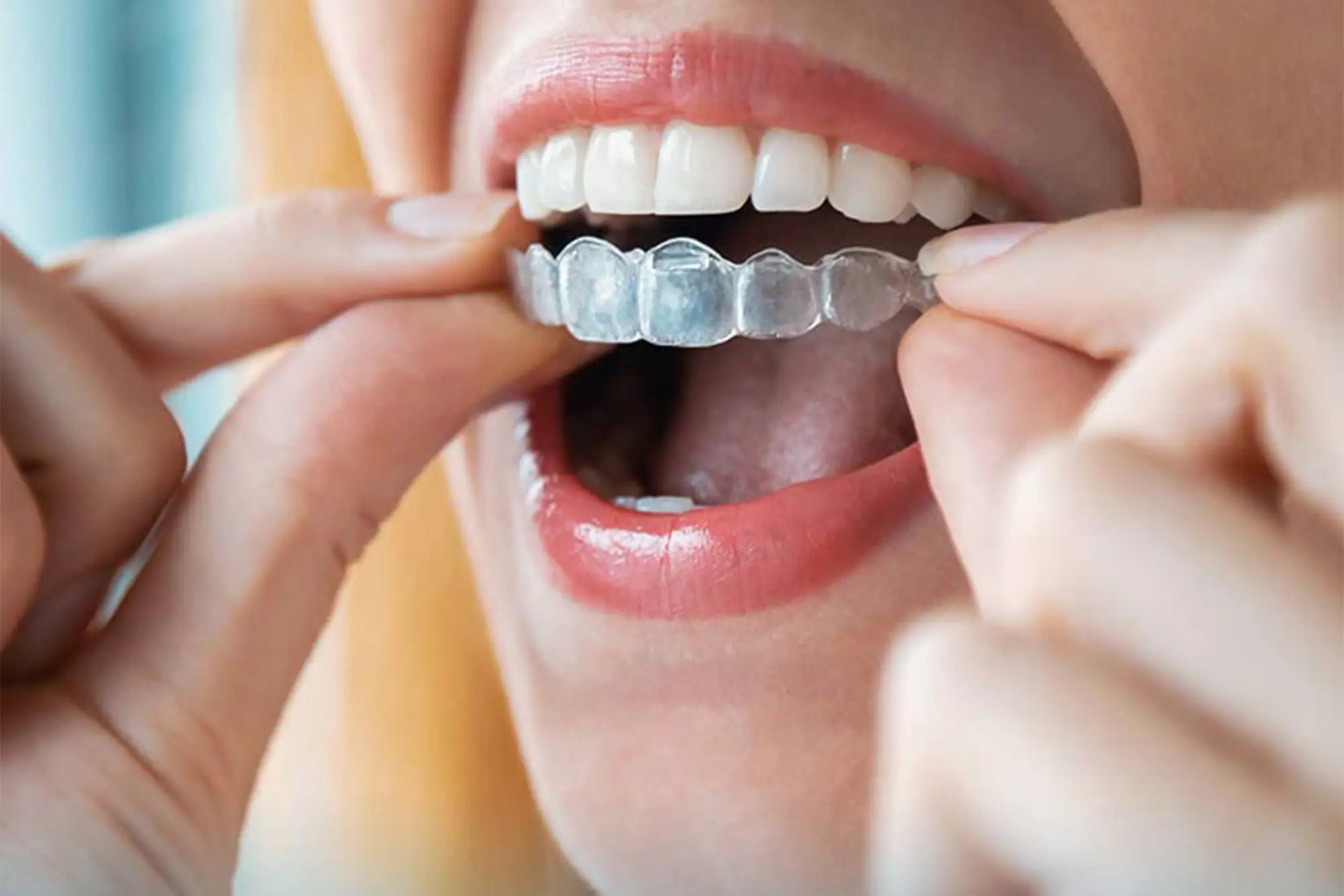 Invisalign