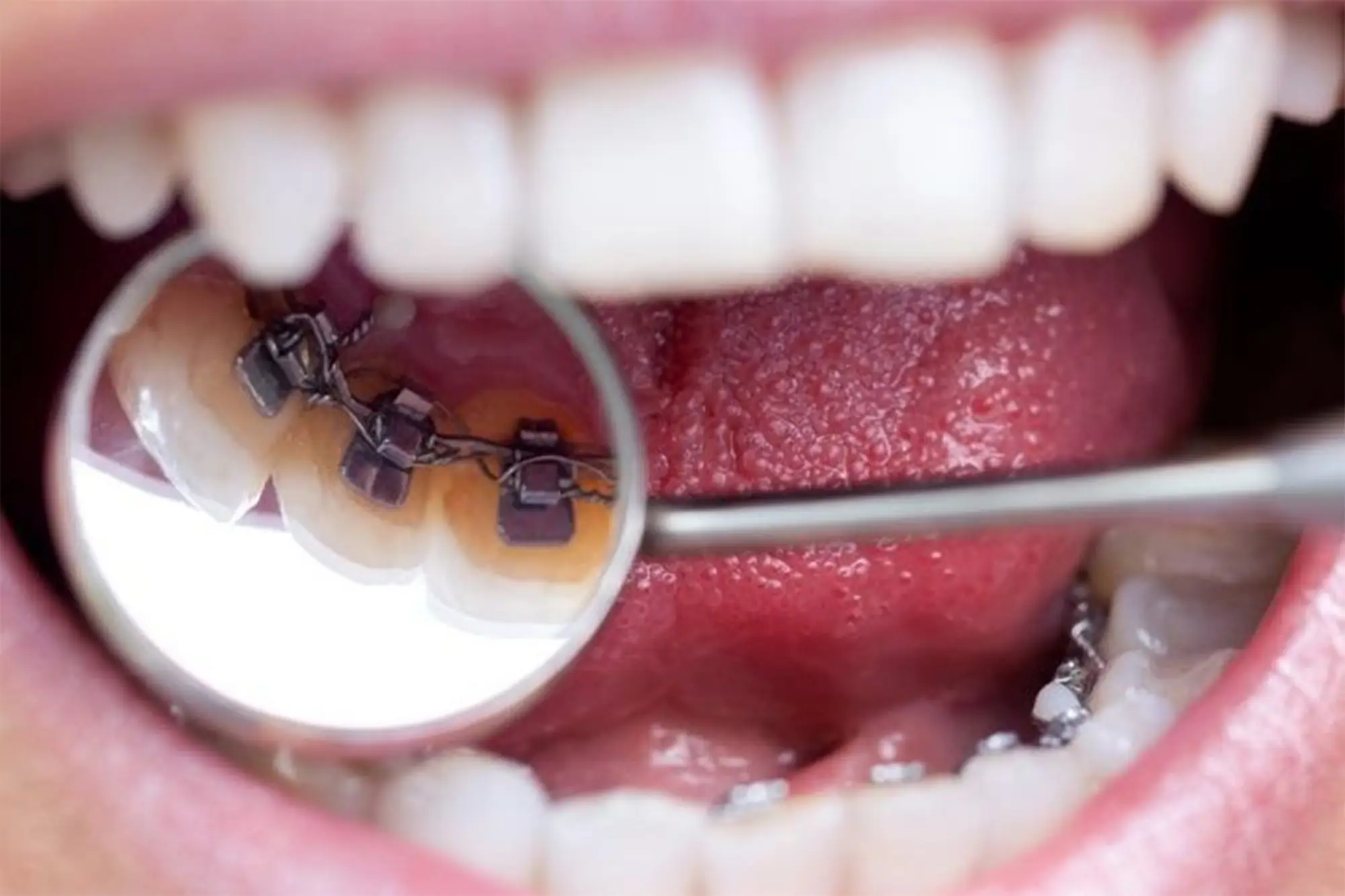 Lingual Braces
