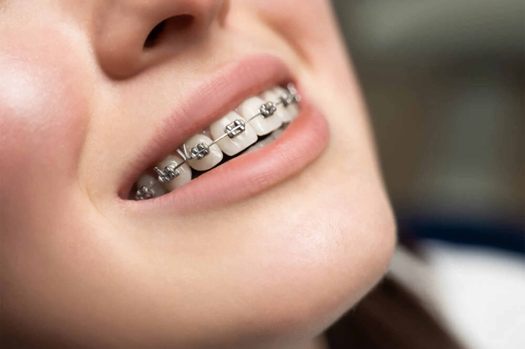 Traditional Braces